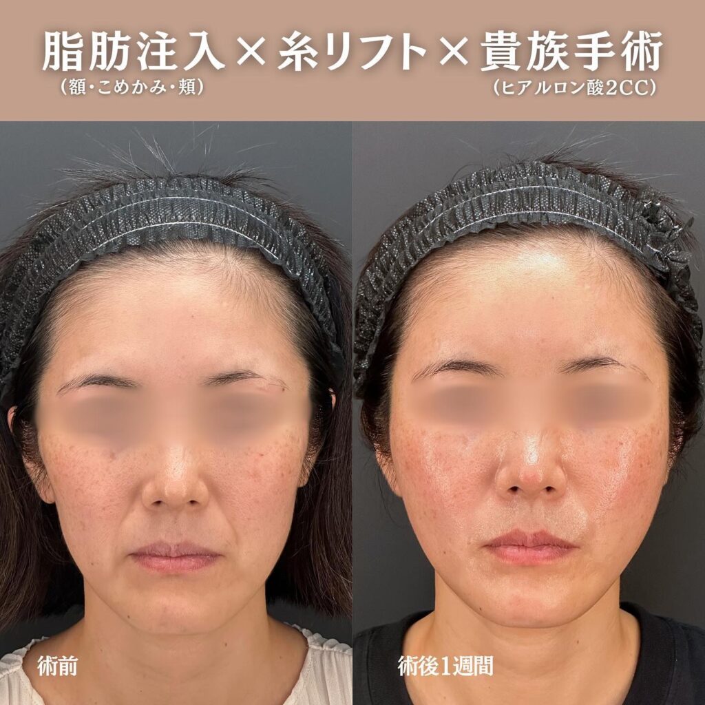 脂肪注入と糸リフトと貴族手術の症例写真