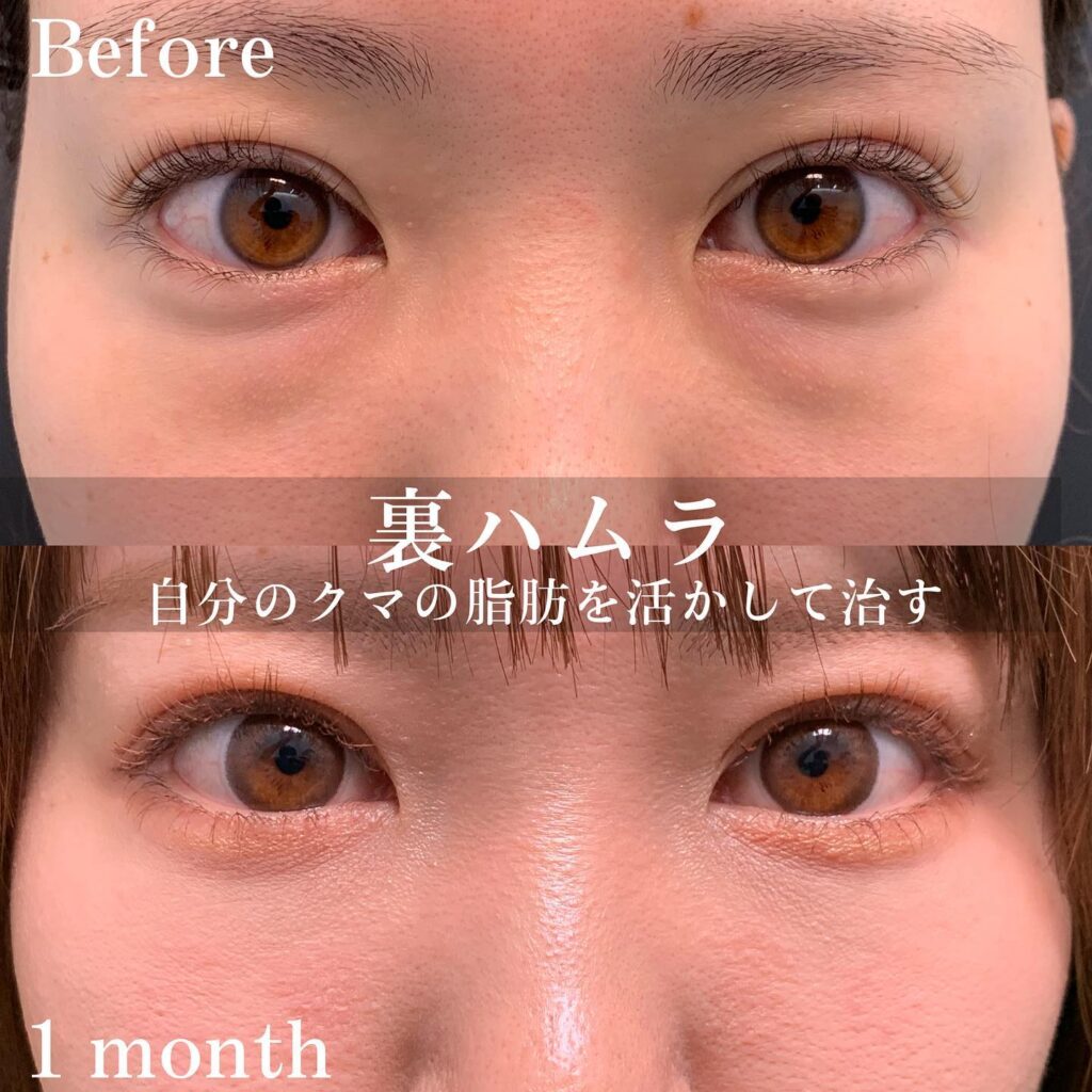 裏ハムラ法の症例写真