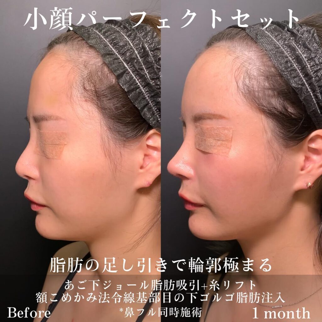 顎下、ジョールの脂肪吸引と糸リフトと脂肪注入の症例写真
