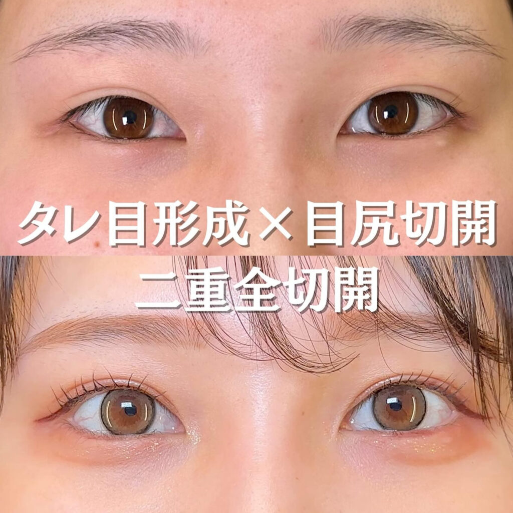 全切開とタレ目形成の症例