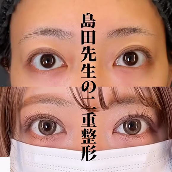 二重整形