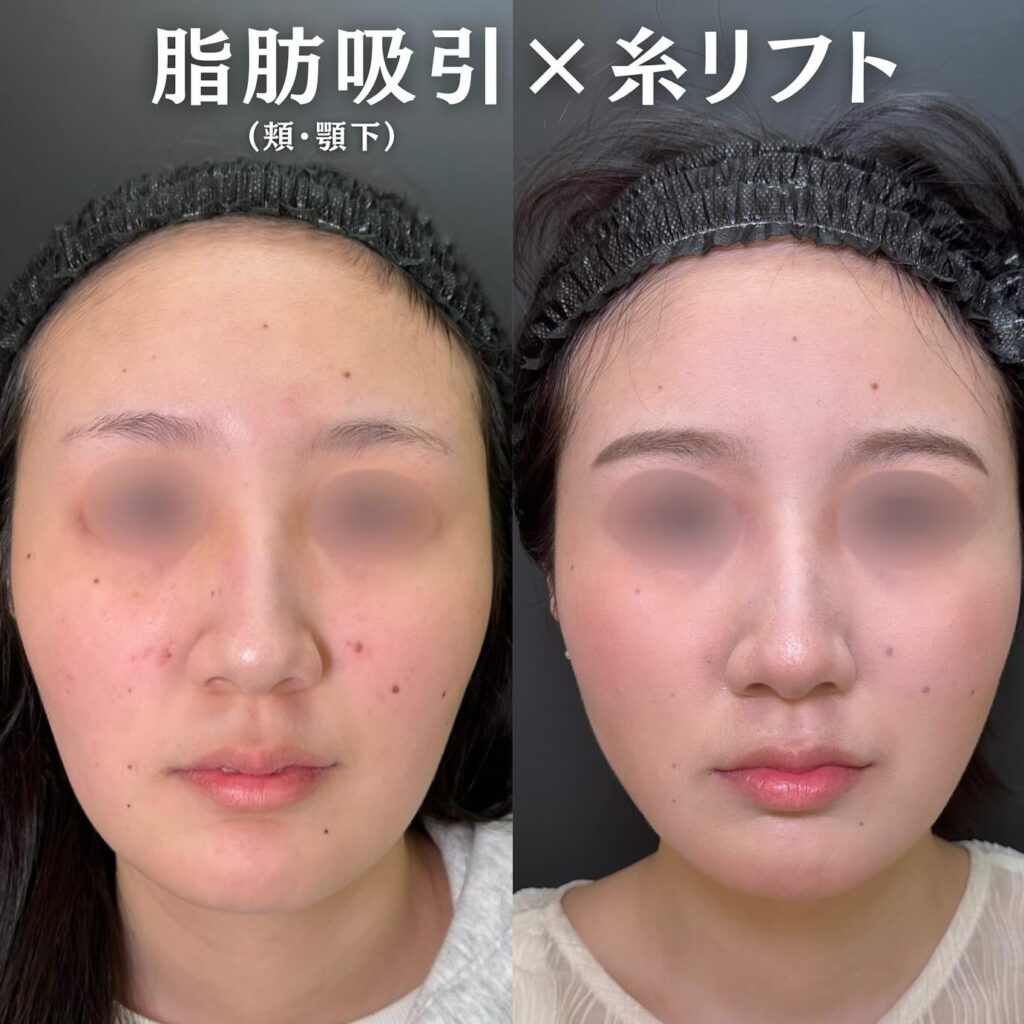 脂肪吸引と糸リフトの症例写真