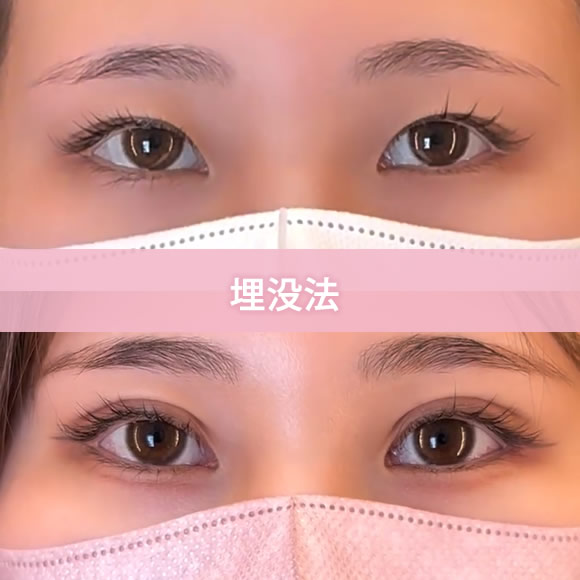 埋没法の症例