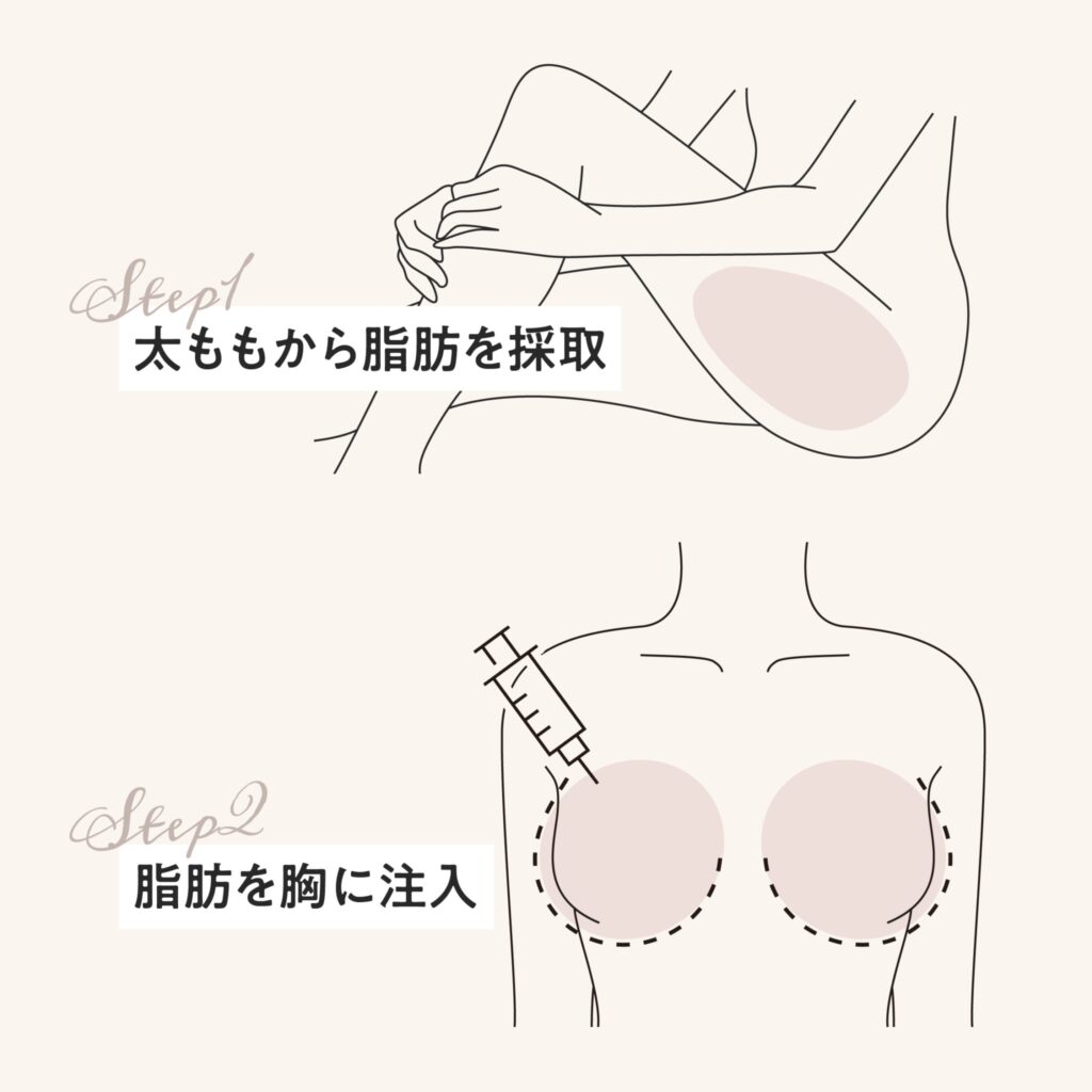 ふんわりバスト注射の図解