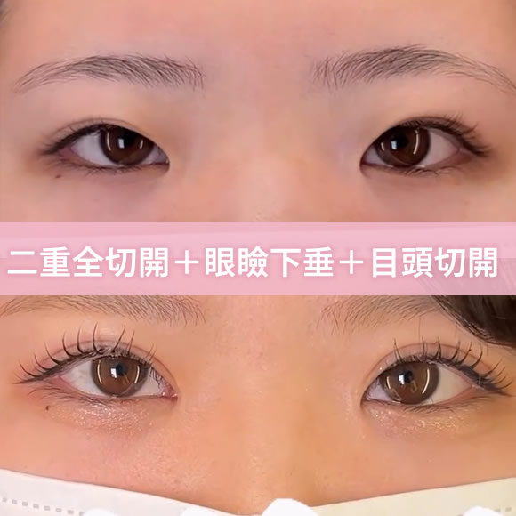 全切開と眼瞼下垂と目頭切開の症例