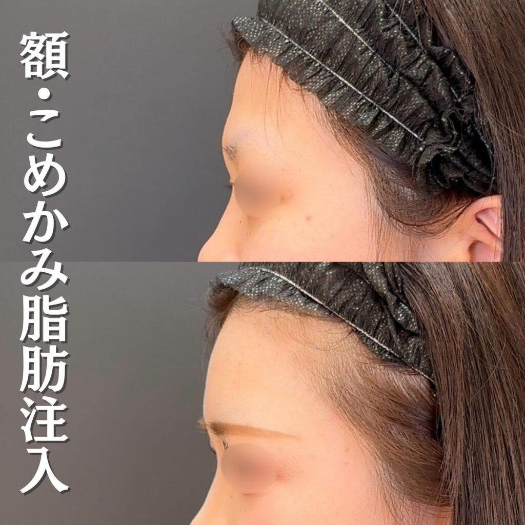 脂肪注入の症例写真