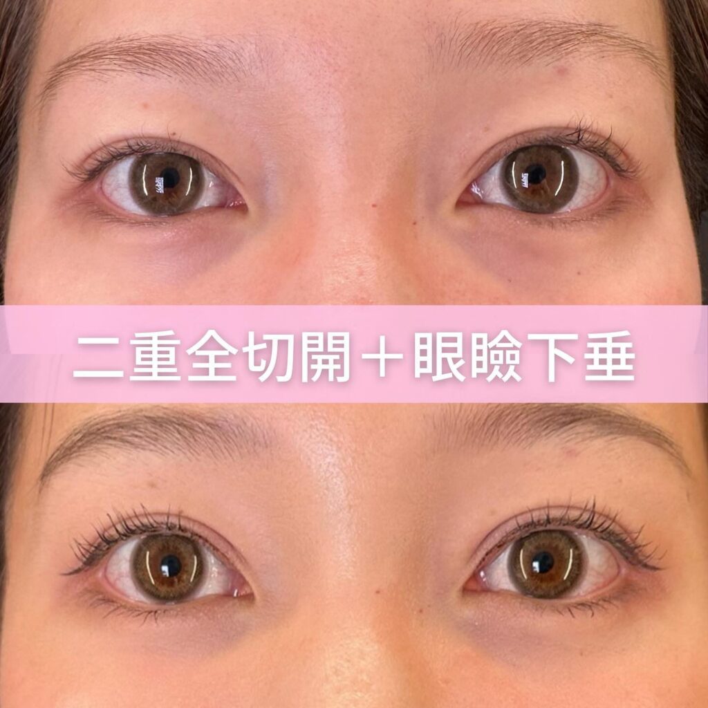 全切開と眼瞼下垂の症例