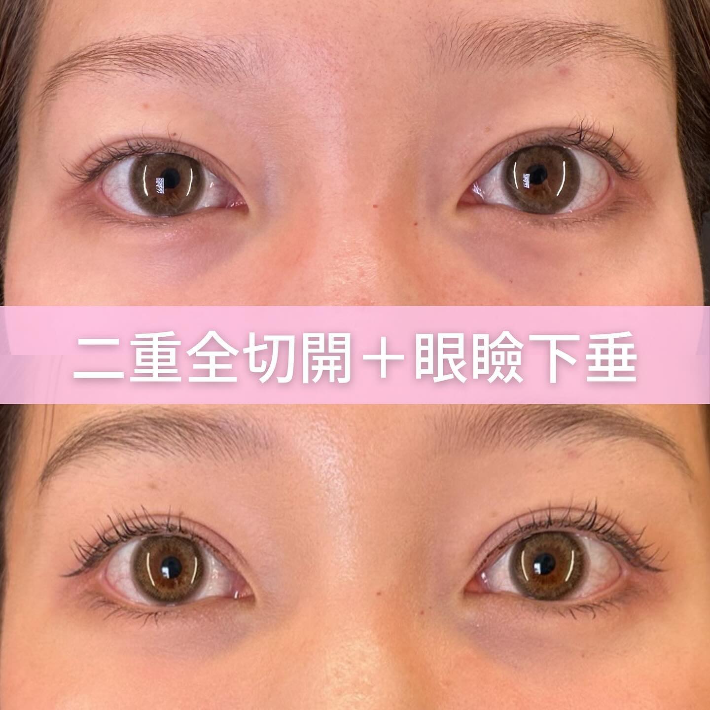 全切開と眼瞼下垂の症例