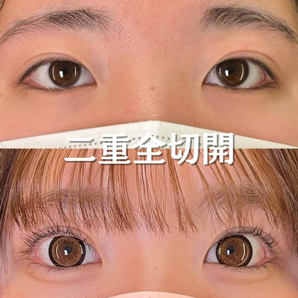 全切開の症例
