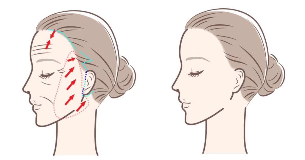フェイスリフト(切開法)のイメージ