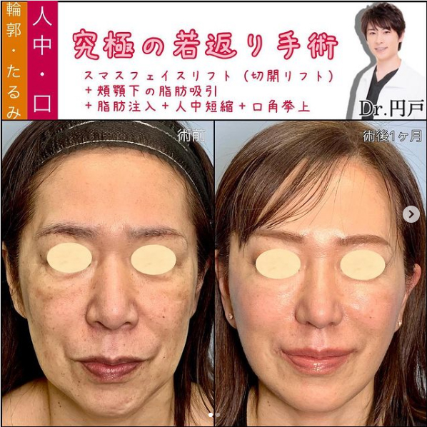 フェイスリフトの症例写真
