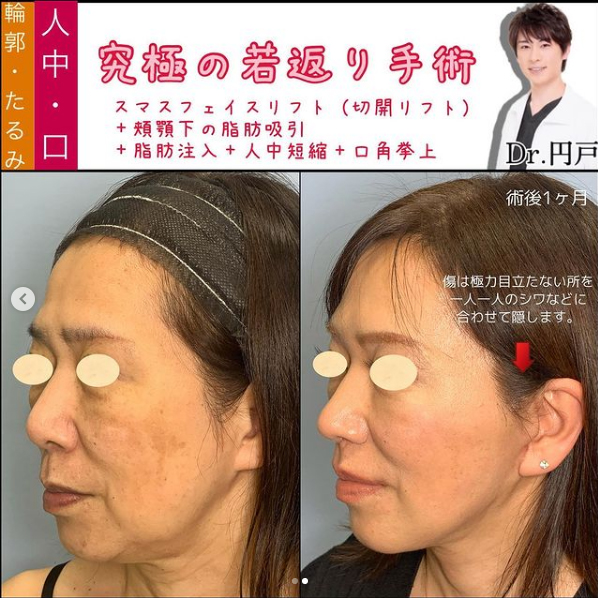 究極の若作りの症例写真