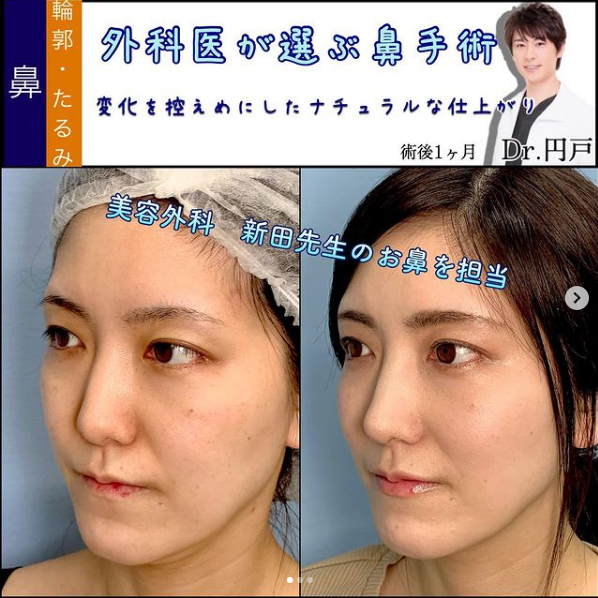 糸リフトの症例写真