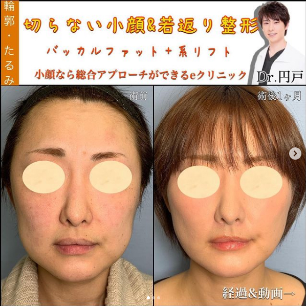バッカルファットと糸リフトの症例写真