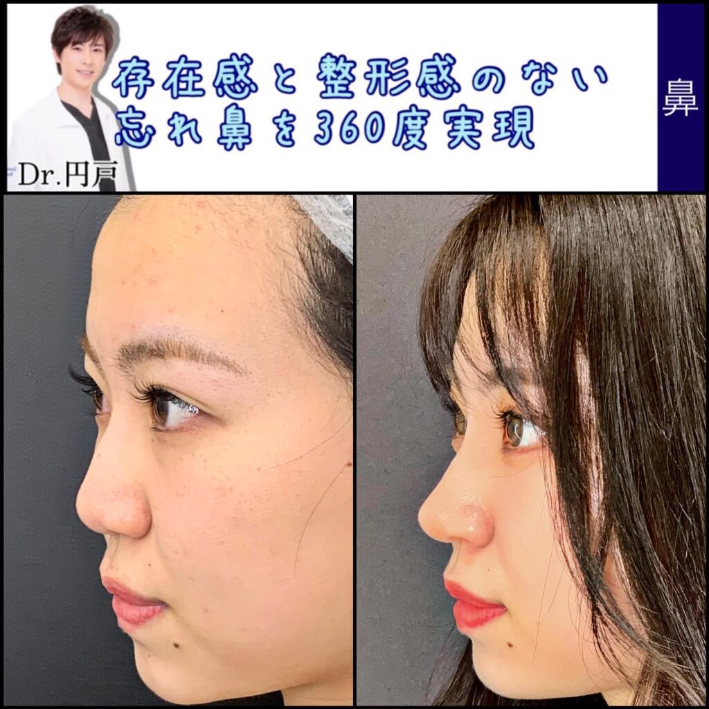 鼻尖形成と軟骨移植と鼻中隔延長と法令線基部人口真皮と鼻背部軟骨移植と小鼻縮小の症例写真