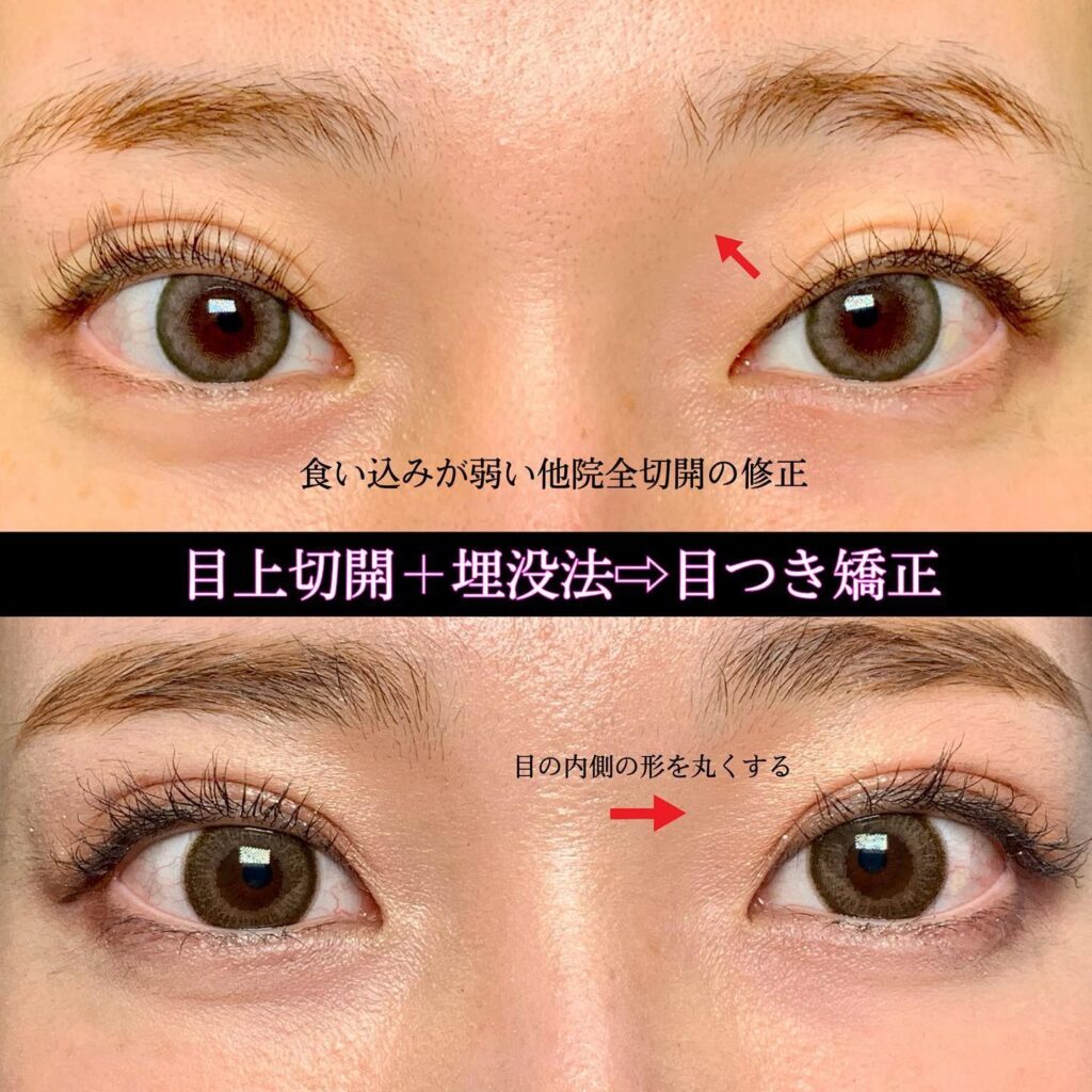 目つき修正の症例
