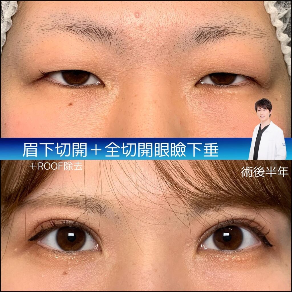 眉下切開と全切開と眼瞼下垂の症例