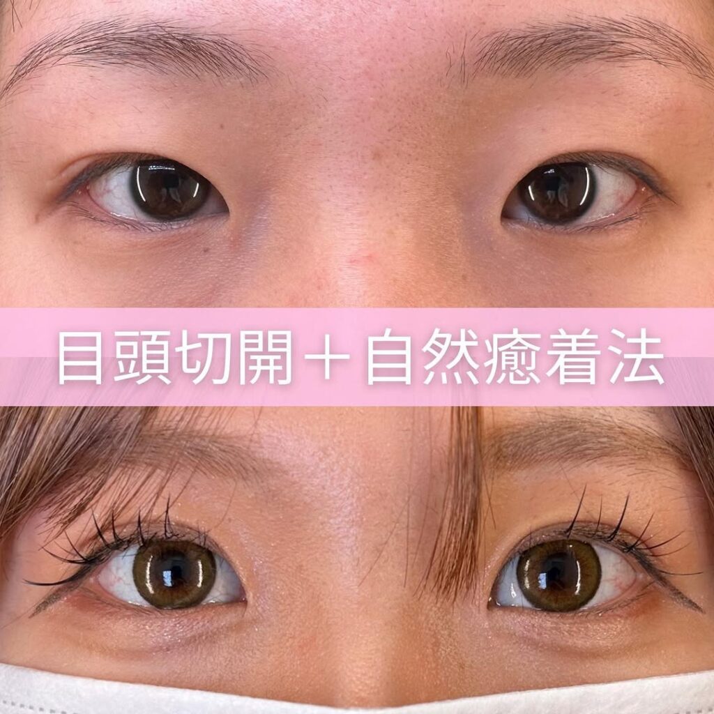 目頭切開と自然癒着法の症例写真