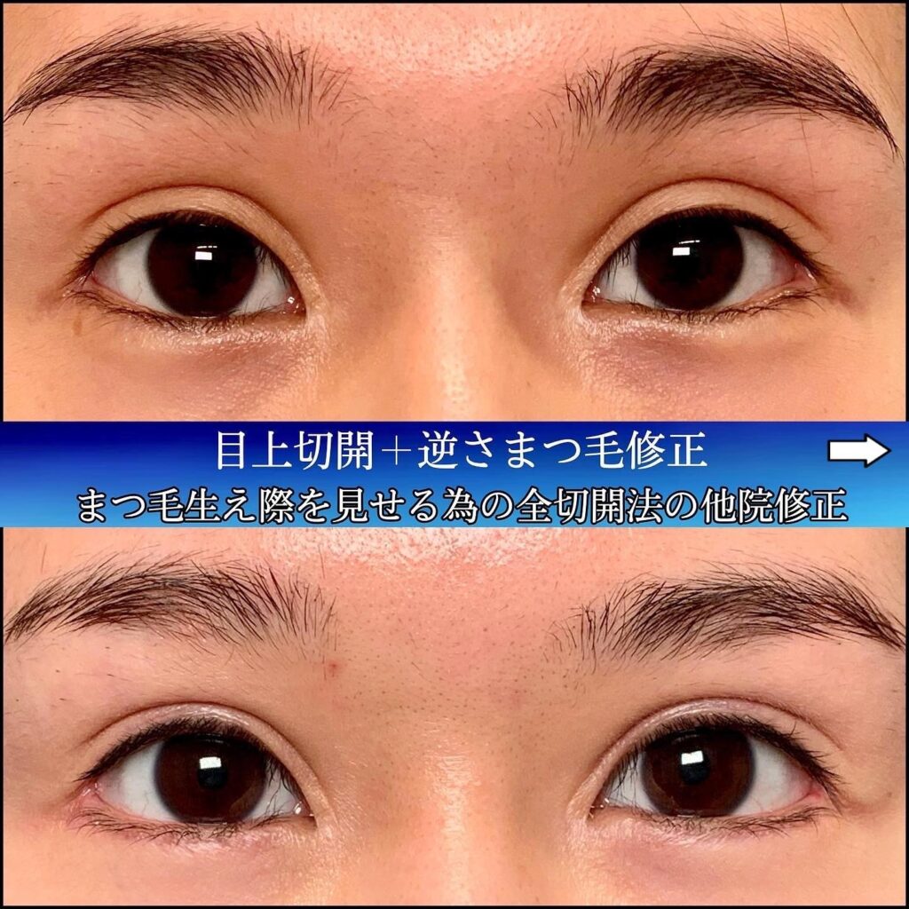 目上切開と逆さまつげ修正の症例