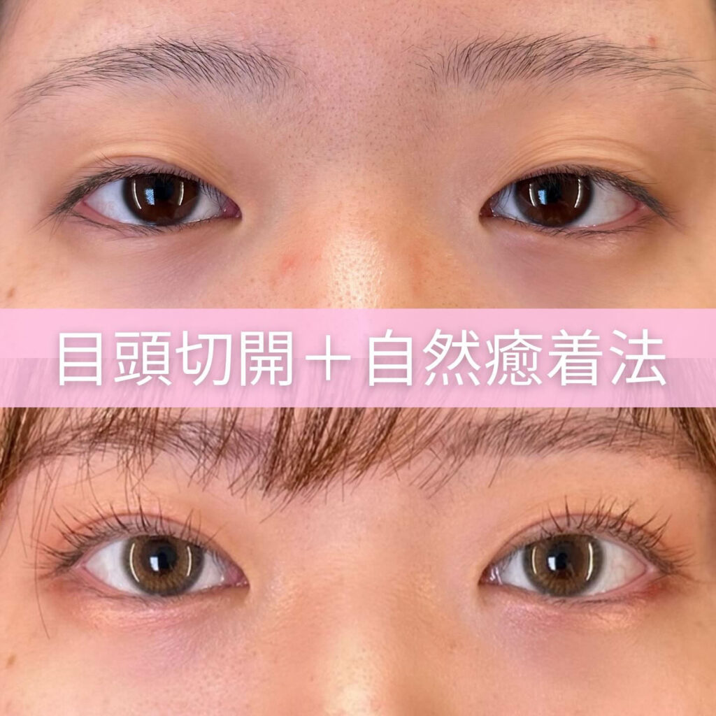 目頭切開と自然癒着法の症例画像
