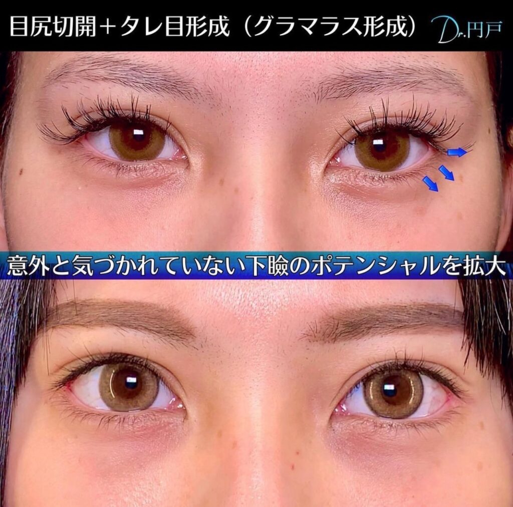 目尻切開とタレ目形成の症例写真 (1)