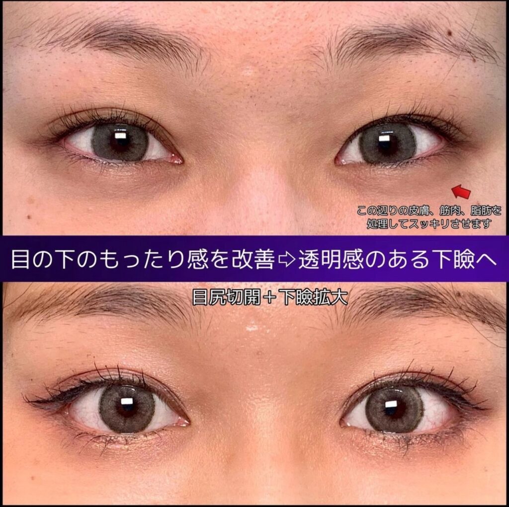 目尻切開とグラマラスライン形成の症例写真