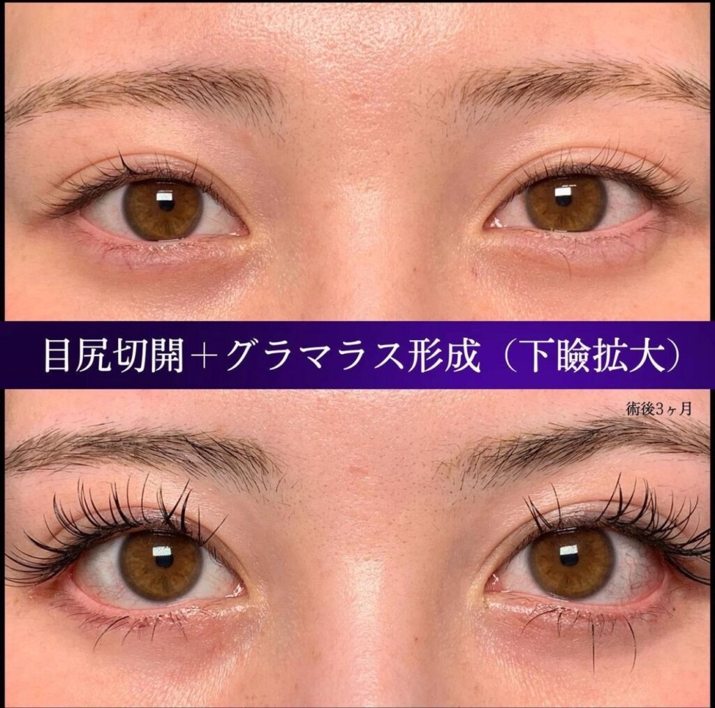 目尻切開とタレ目形成の症例写真 (2)