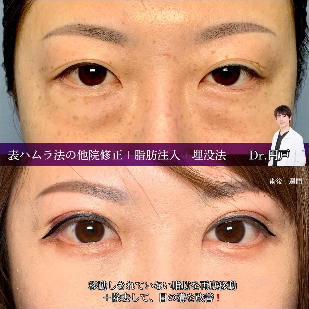 裏ハムラ法の他院修正と脂肪注入と埋没法の症例写真
