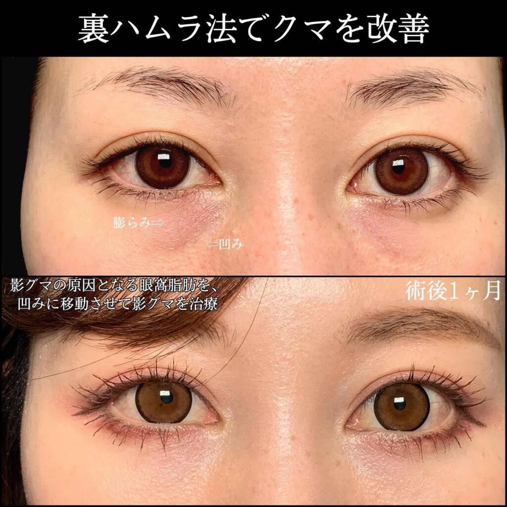 裏ハムラ法の症例写真