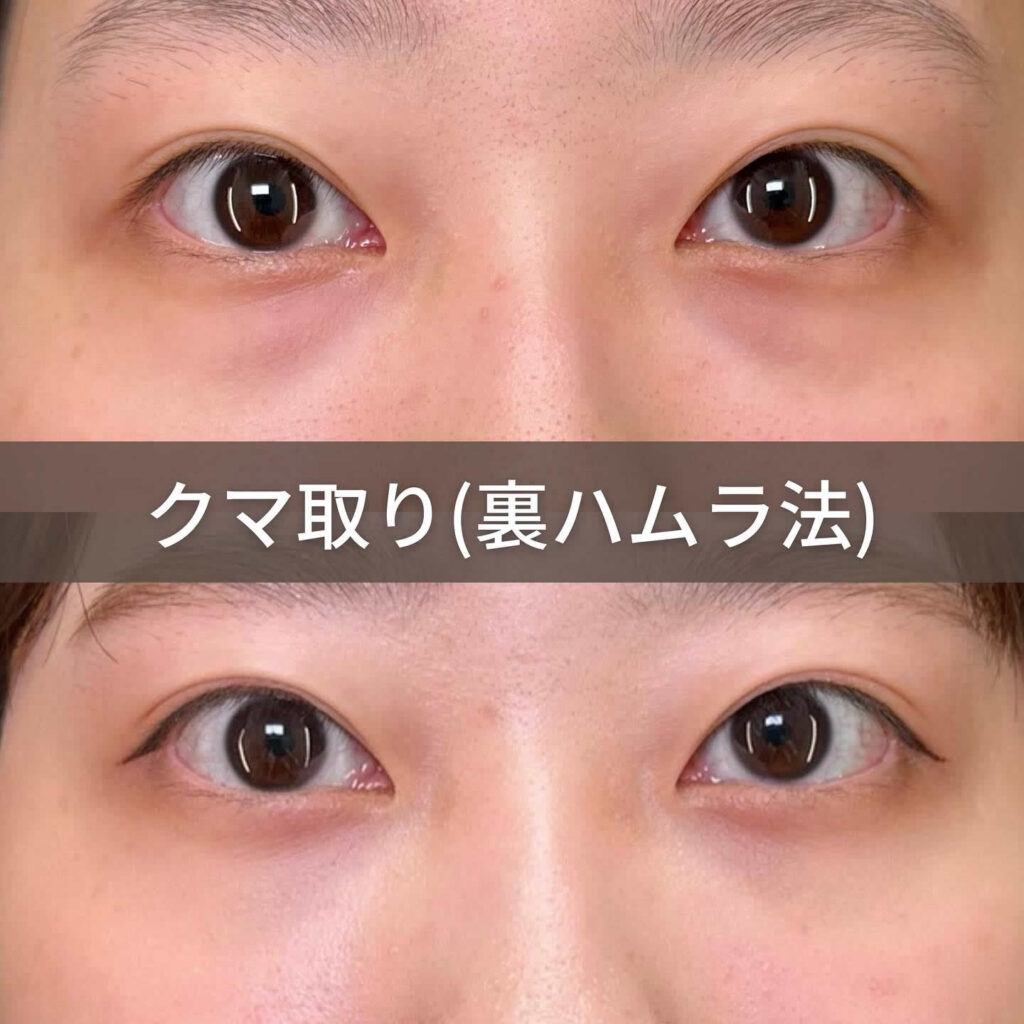 裏ハムラ法の症例写真