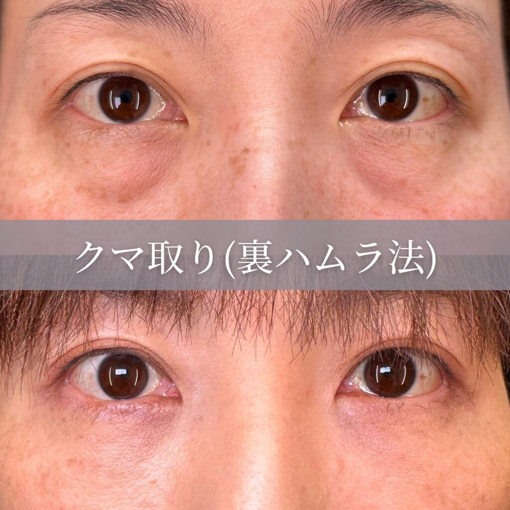 クマ取りの症例写真