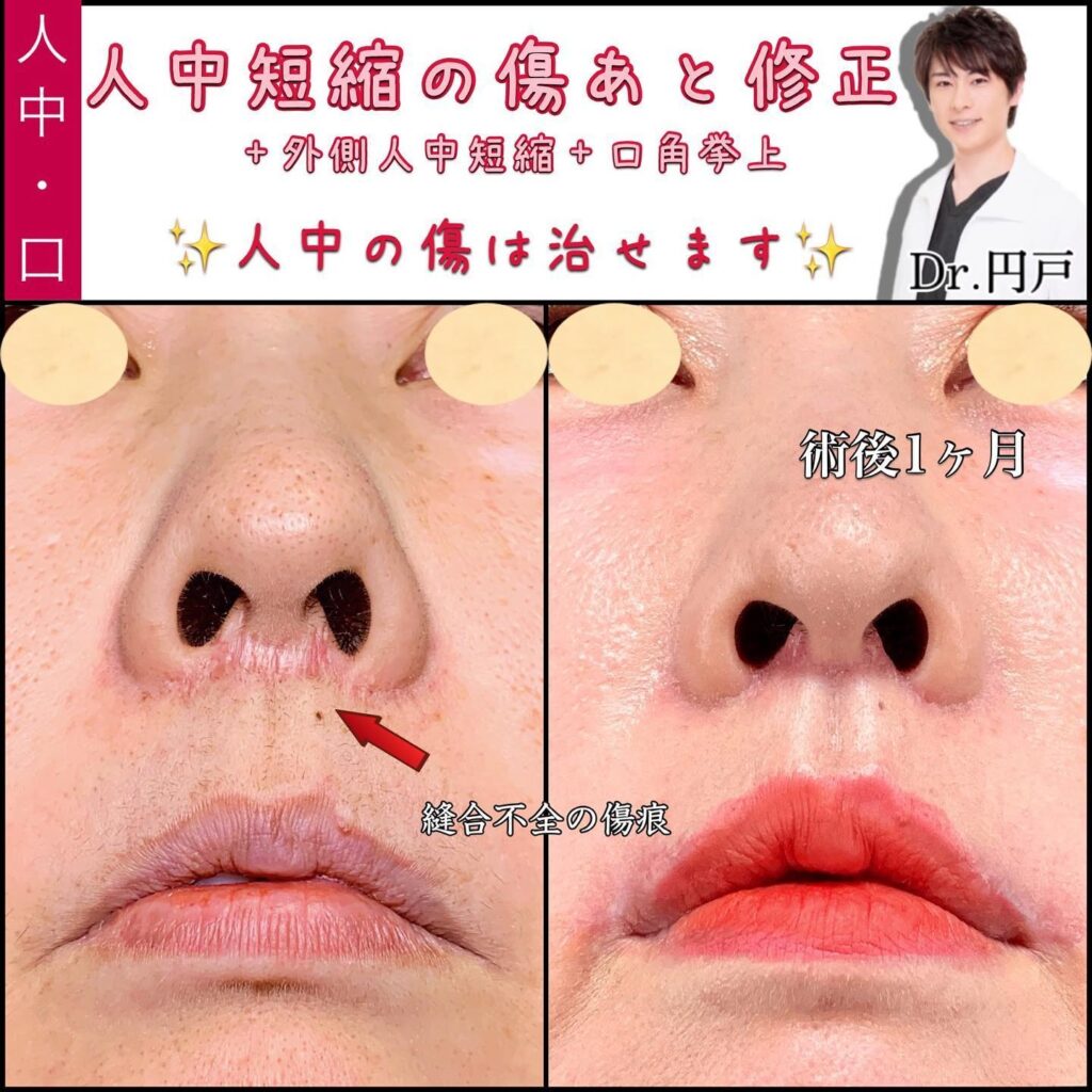 他院修正と外側人中短縮と口角挙上の症例写真