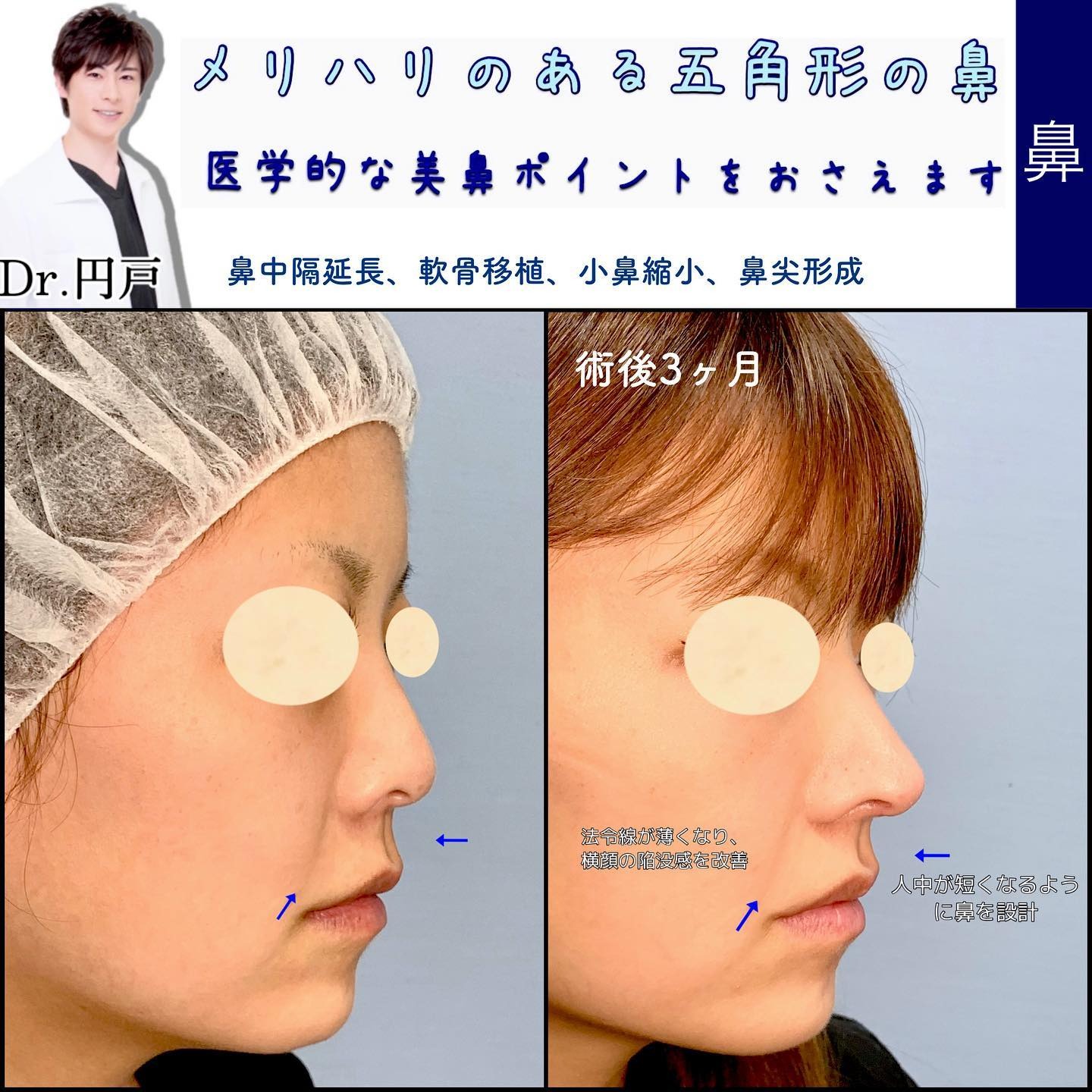 鼻中隔延長と軟骨移植と小鼻縮小と鼻尖形成の症例写真