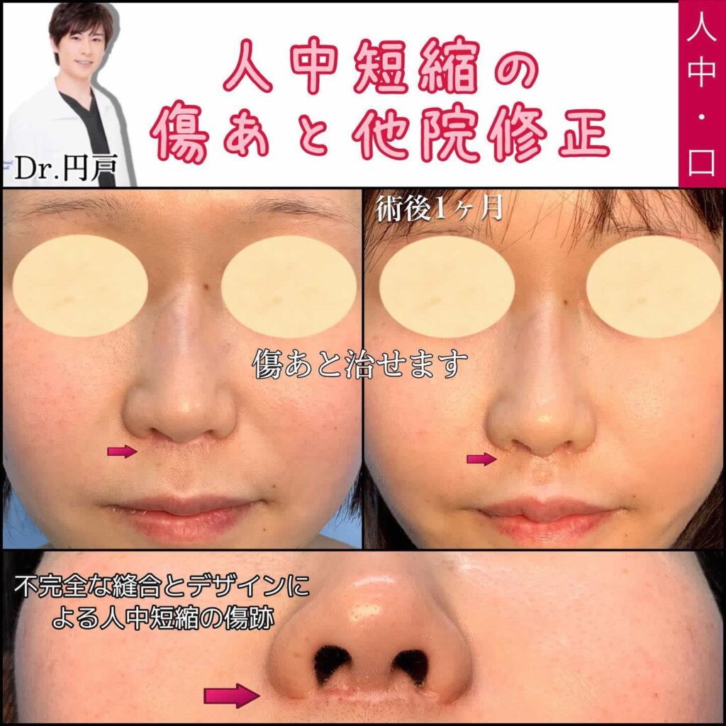 人中短縮の他院修正