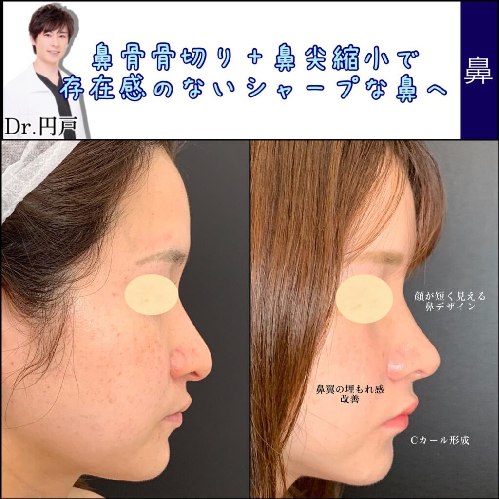 鼻骨骨切りと鼻尖形成の症例写真