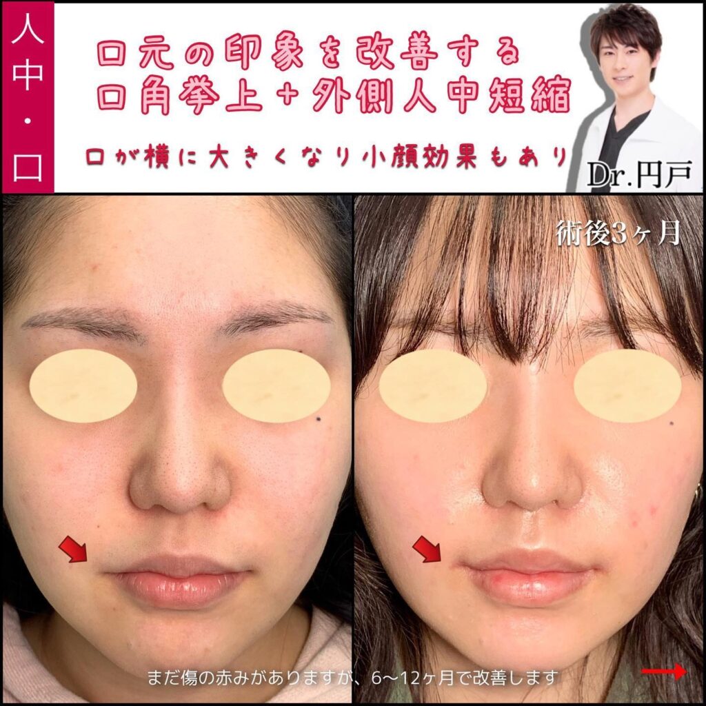 口角挙上と外側人中短縮