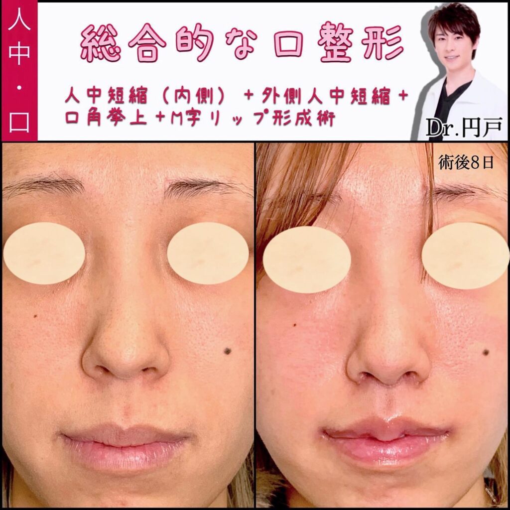 人中短縮と外側人中短縮と口角挙上とM字リップ形成の症例