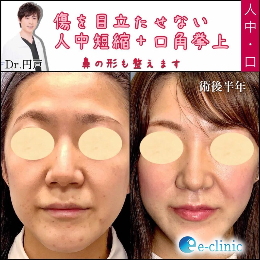 人中短縮と口角挙上の症例写真
