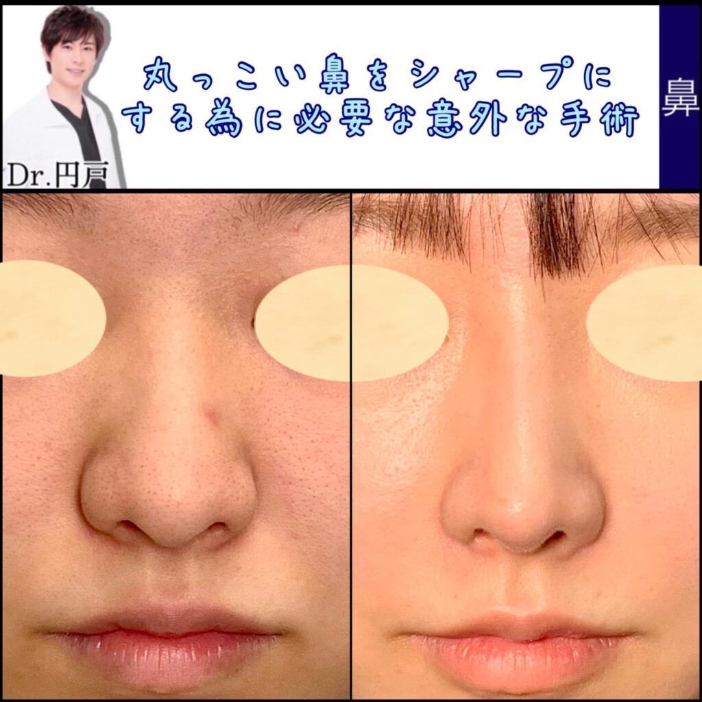 鼻尖形成と軟骨移植と鼻中隔延長と鼻孔縁軟骨移植の症例写真