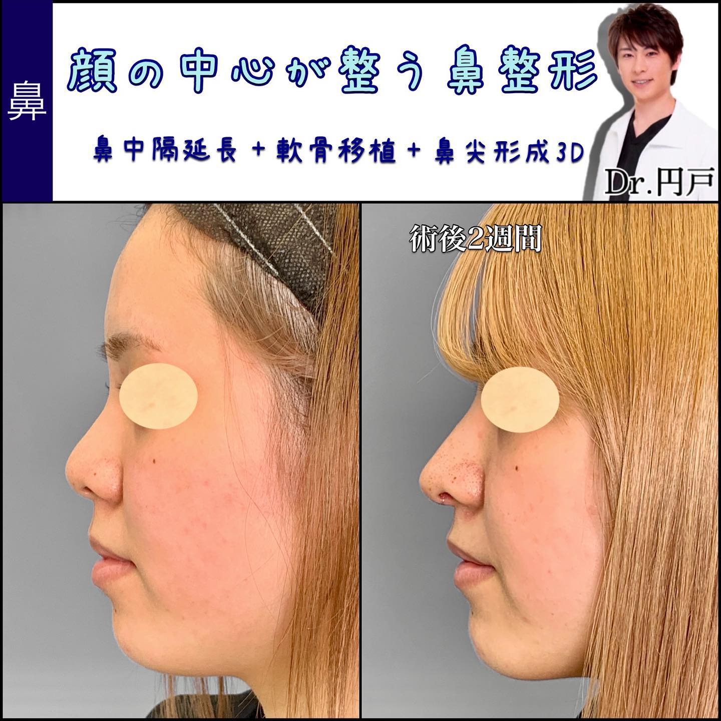 鼻中隔延長と軟骨移植と鼻尖形成3D法の症例写真