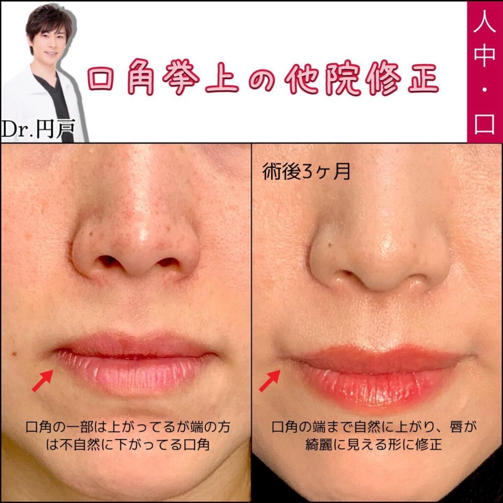 口角挙上の他院修正