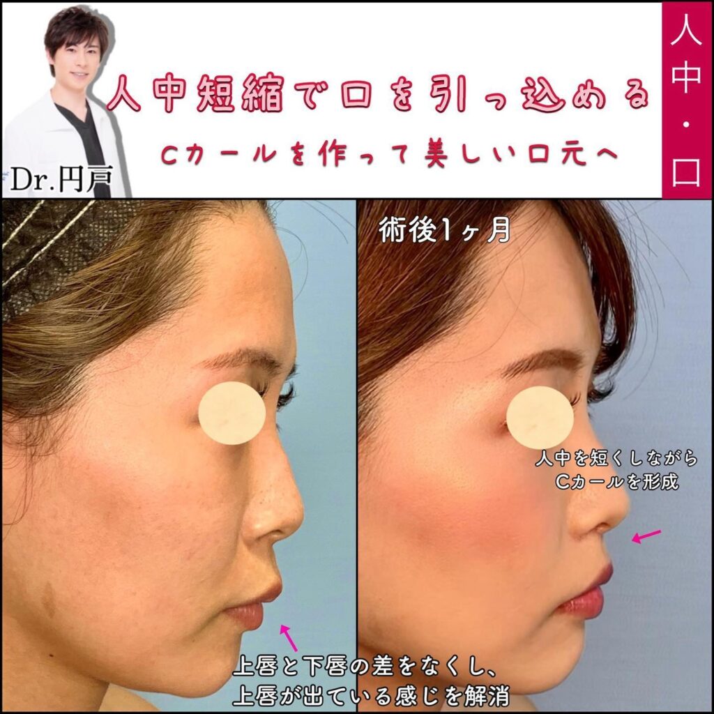 人中短縮の症例写真