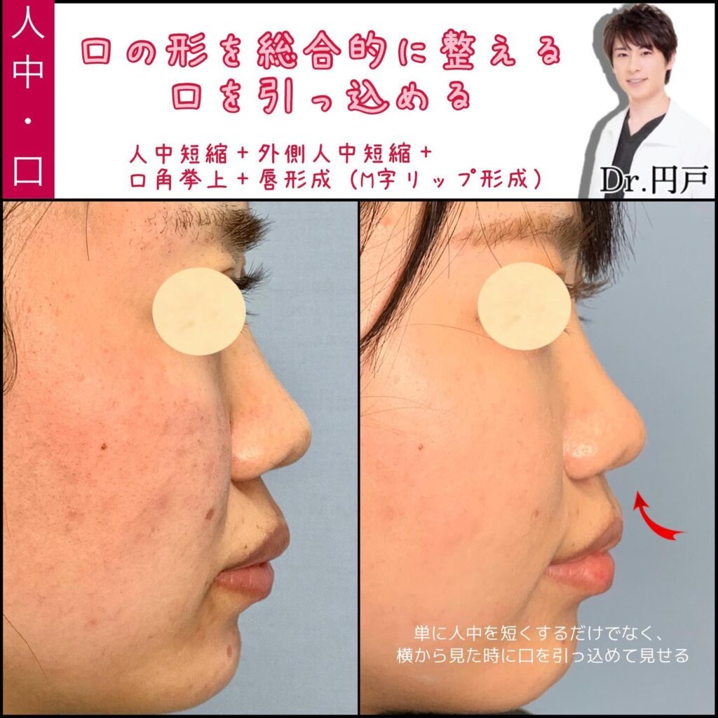 人中短縮と外側人中短縮と口角挙上とM字リップの症例写真