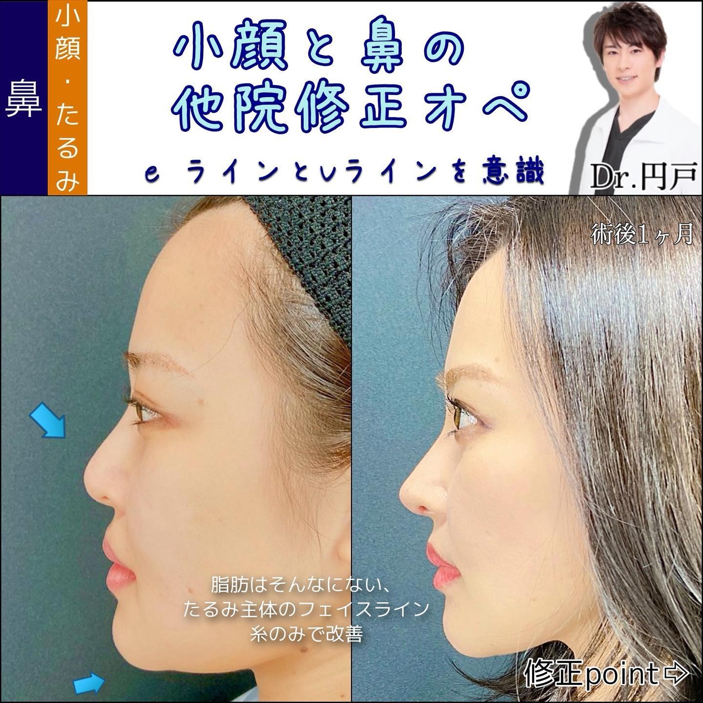 鼻の他院修正と糸リフトの症例写真