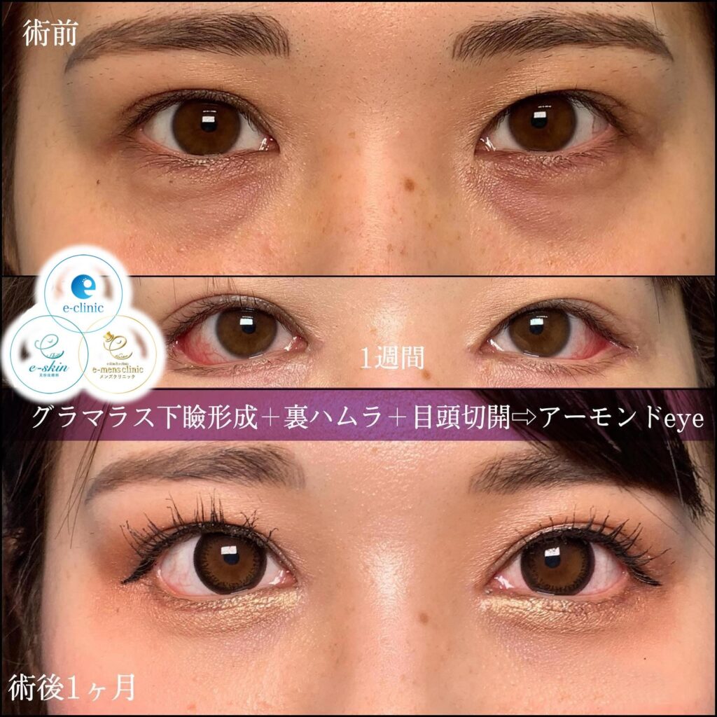 グラマラスライン形成と裏ハムラ法と目頭切開の症例写真