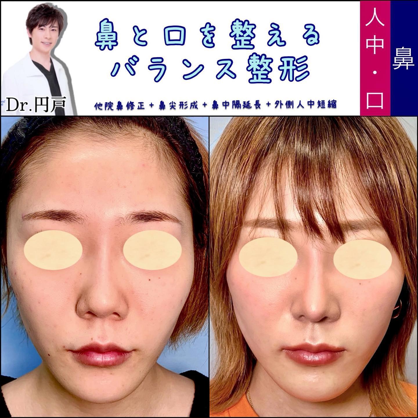 鼻の他院修正と鼻尖形成と鼻中隔延長と人中短縮の症例写真