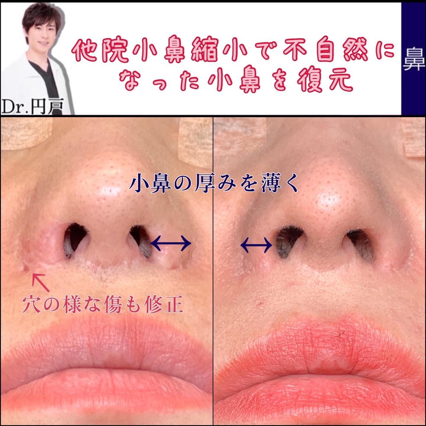 小鼻縮小の他院修正
