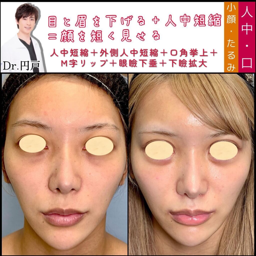 人中短縮と外側人中短縮と口角挙上とM字リップと眼瞼下垂と下瞼拡大の症例写真