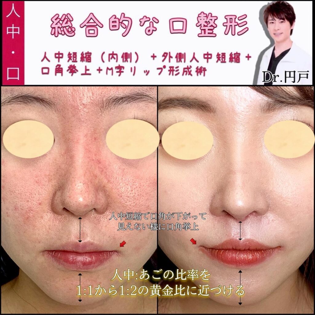 人中短縮と外側人中短縮と口角挙上とM字リップ形成の症例写真