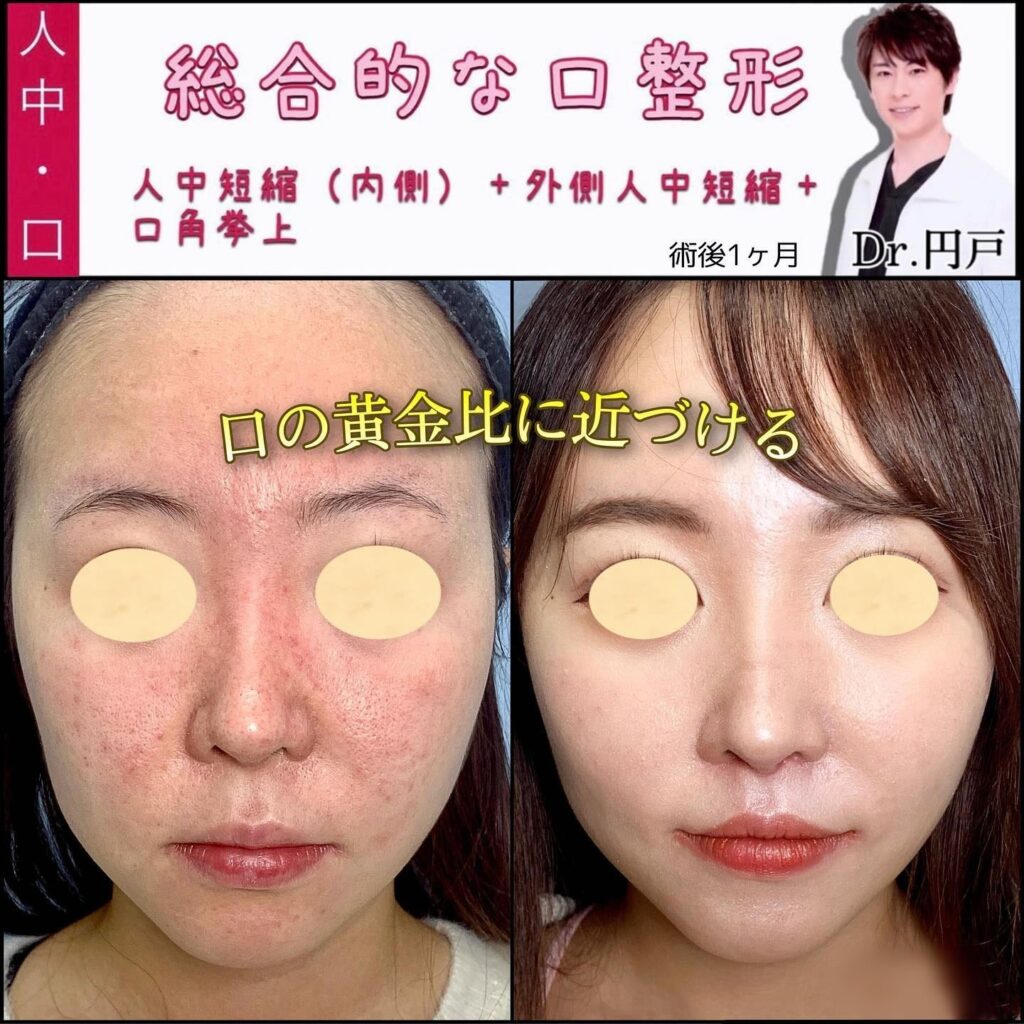 人中短縮と外側人中短縮と口角挙上の症例写真